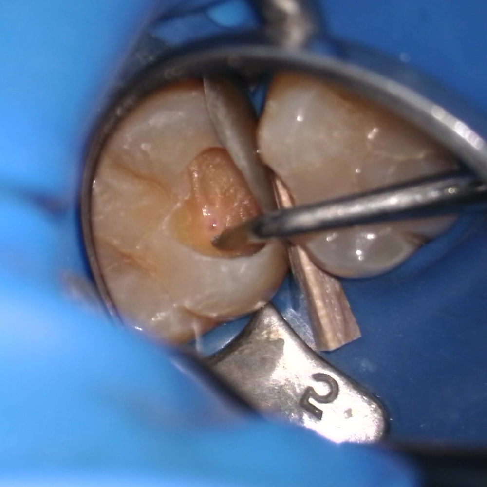 為何要選擇顯微根管治療呢?